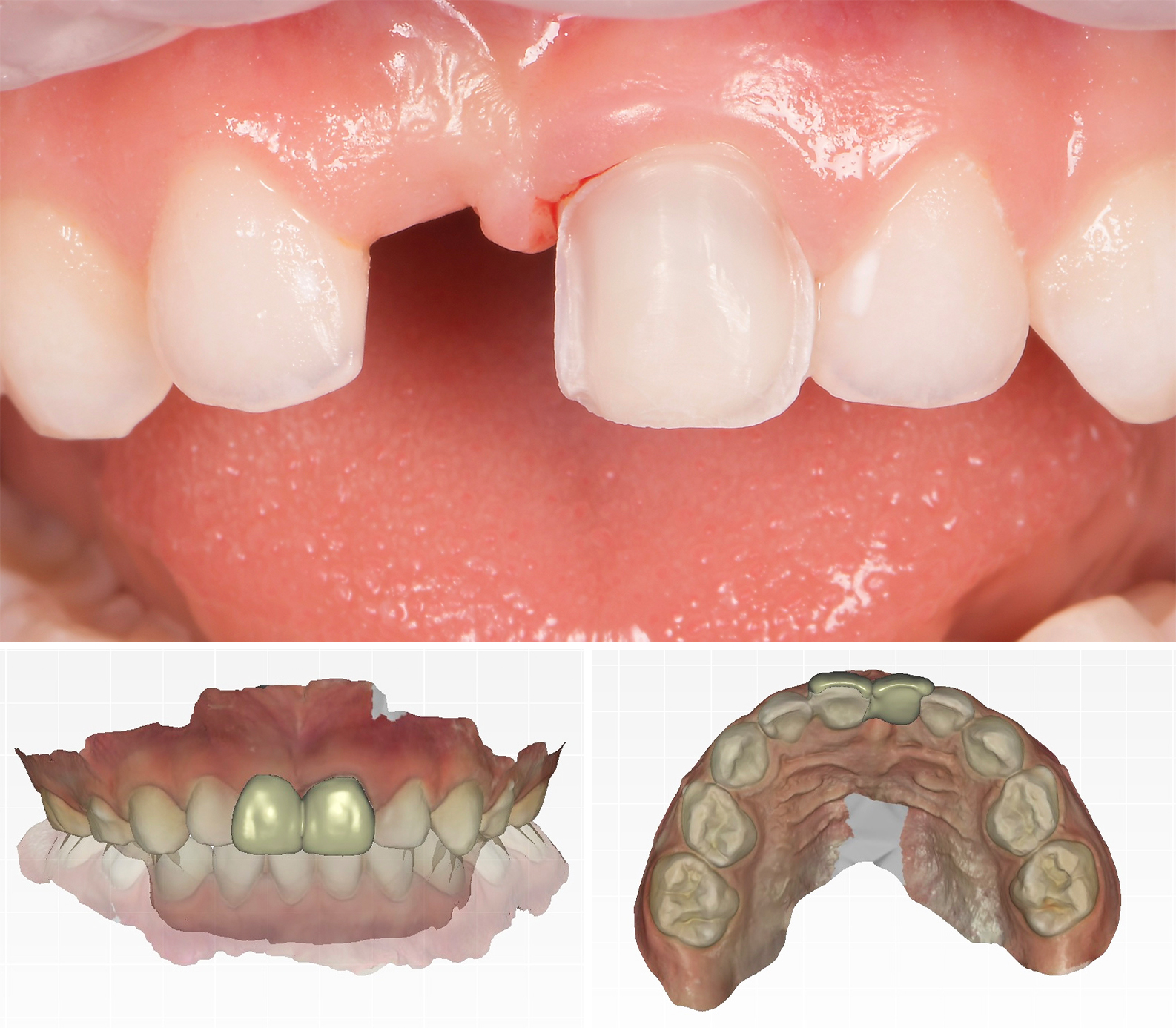 Figure6abc - mainteneur d’espace antérieur collé
