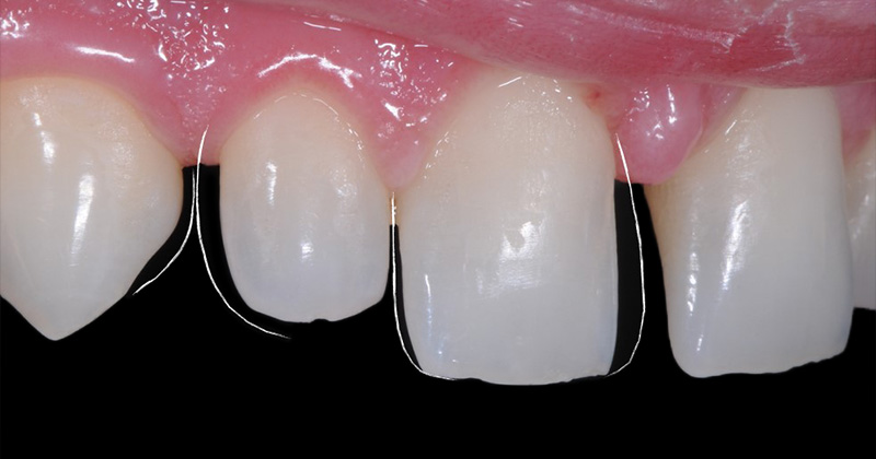 Photo-12-Article-Academie-du-sourire-Cas-C