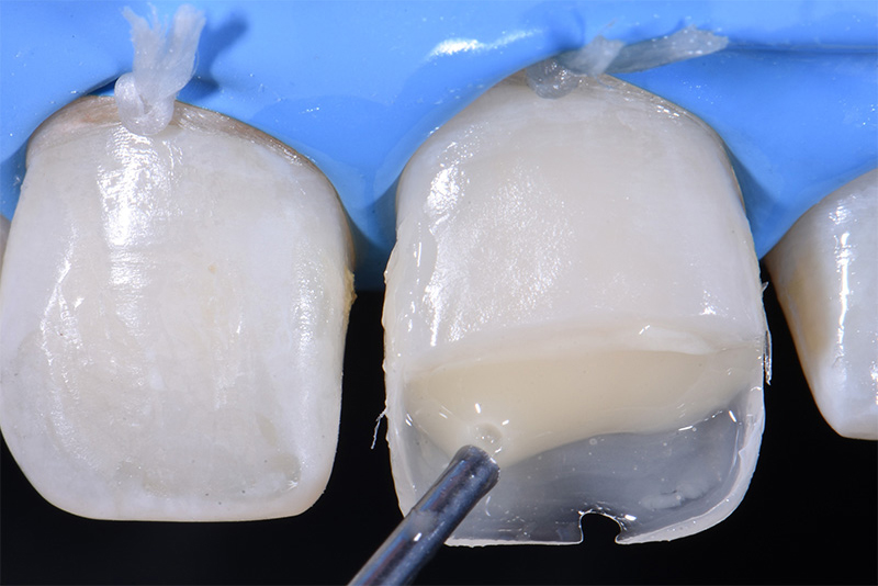 Photo-3-Article-Academie-du-sourire-Cas-A