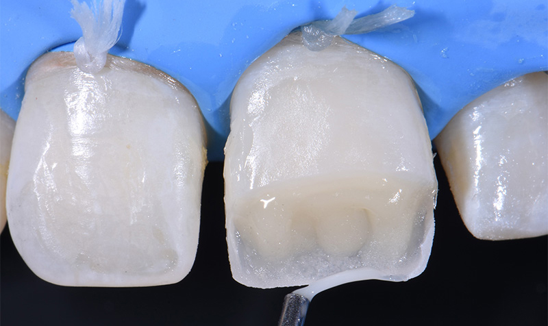 Photo-4-Article-Academie-du-sourire-Cas-A