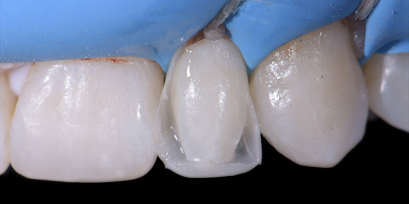 Photo-8-Article-Academie-du-sourire-Cas-B