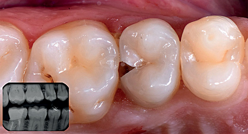 VOCO-composite-fig01