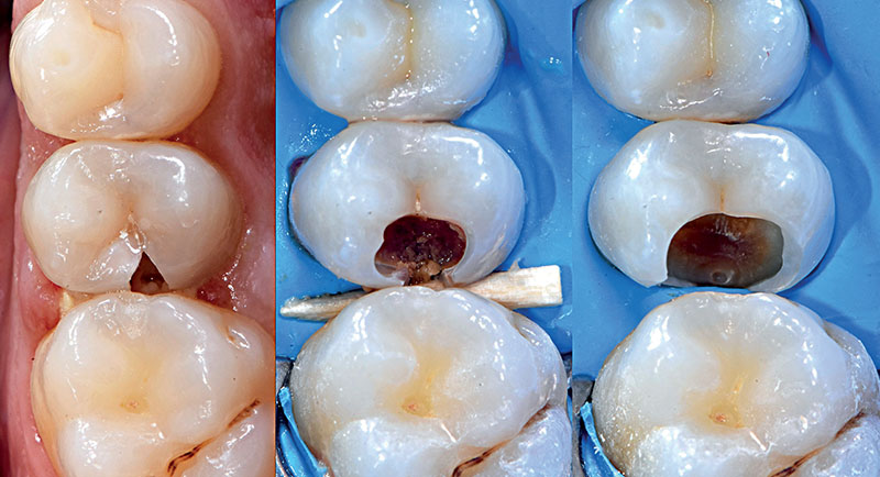 VOCO-composite-fig02