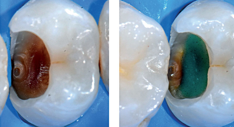 VOCO-composite-fig03