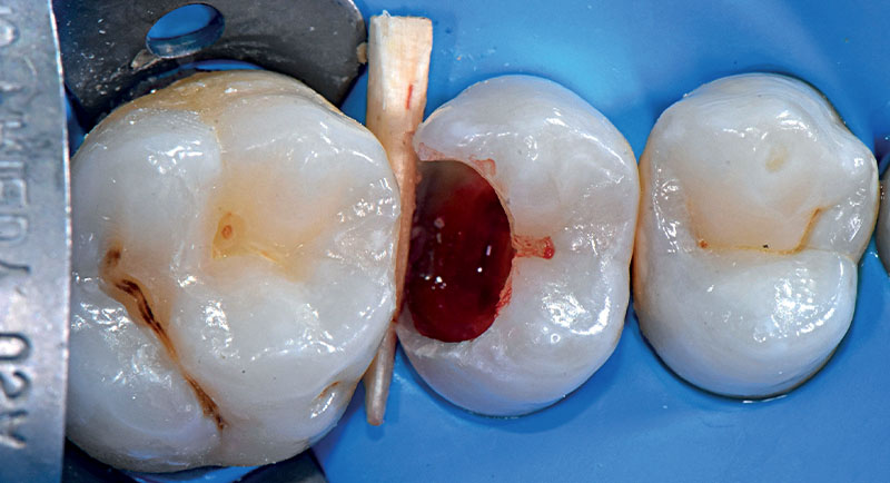 VOCO-composite-fig04