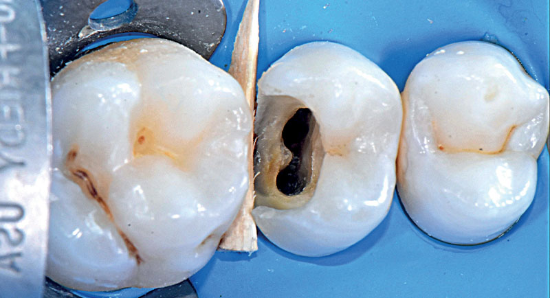 VOCO-composite-fig05