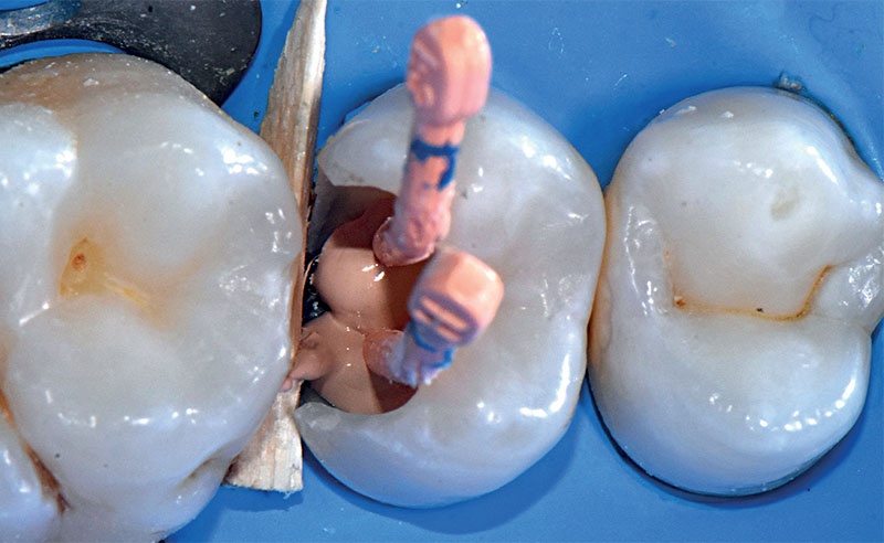 VOCO-composite-fig06