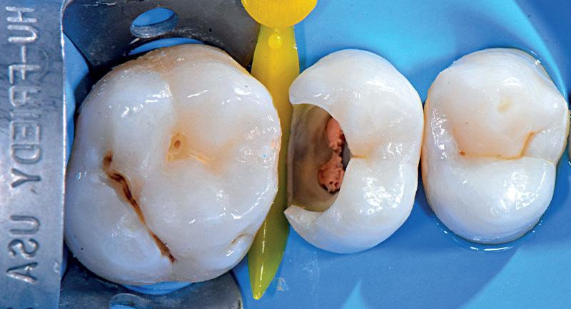 VOCO-composite-fig07