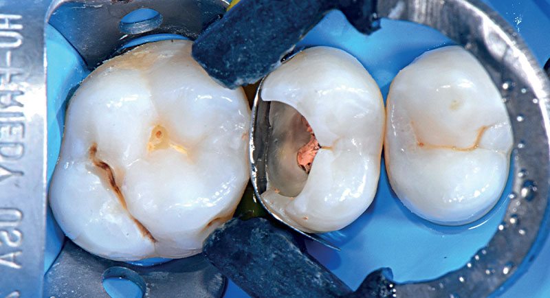 VOCO-composite-fig08