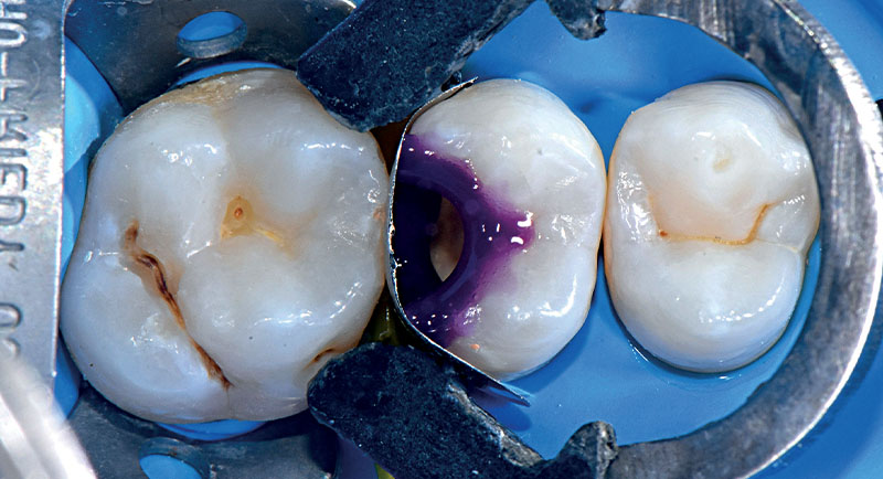 VOCO-composite-fig09