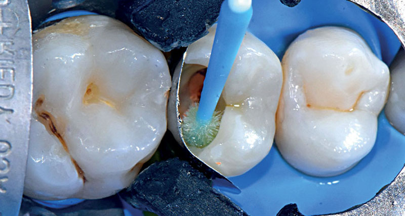 VOCO-composite-fig10