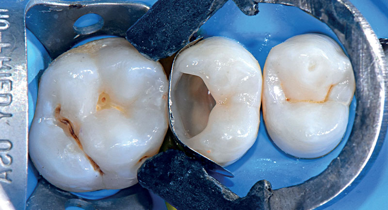 VOCO-composite-fig11