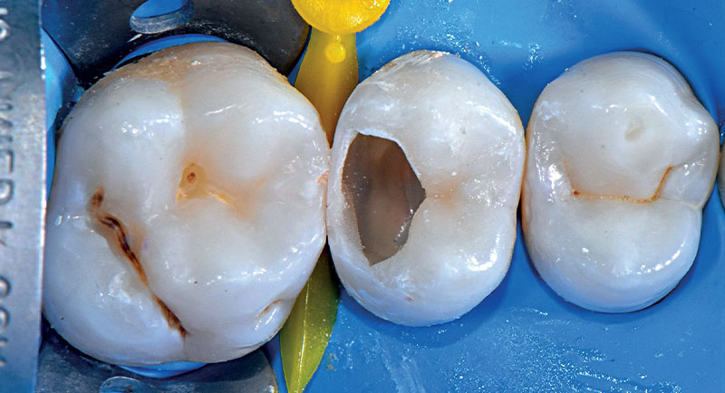 VOCO-composites-fig12