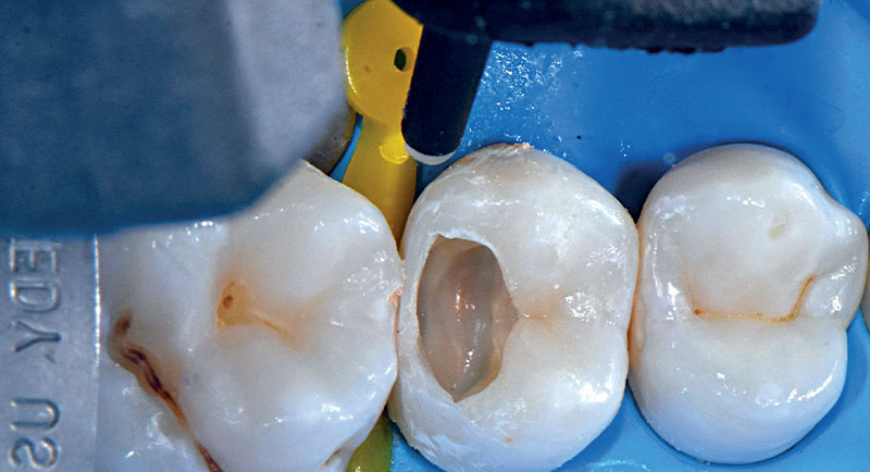 VOCO-composite-fig13