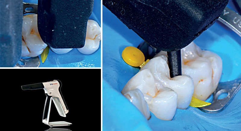 VOCO-composites-fig14