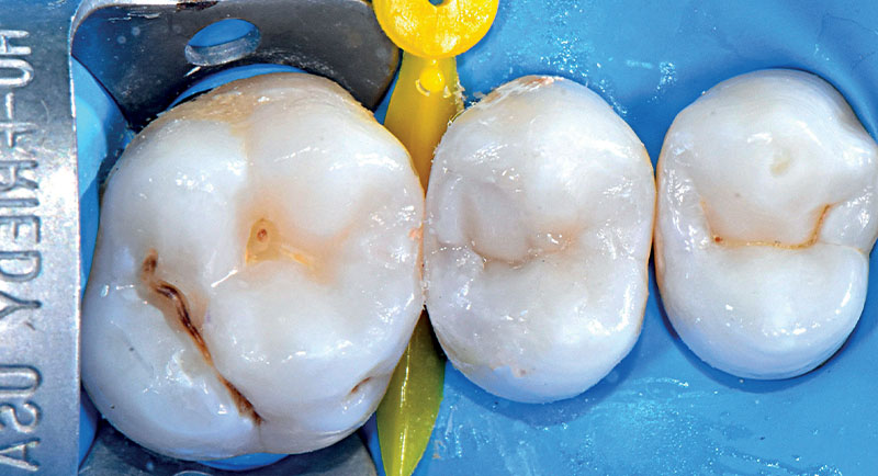 VOCO-composites-fig15