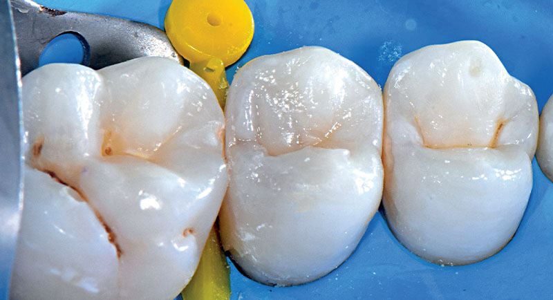 VOCO-composites-fig16