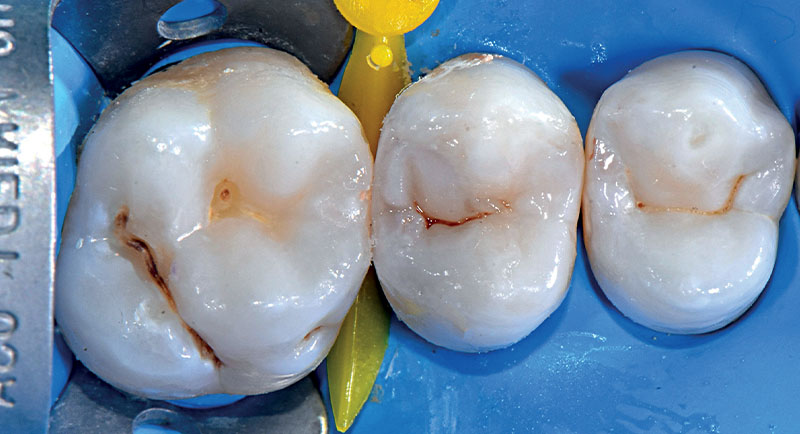 VOCO-composite-fig17