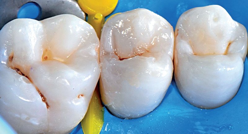 VOCO-composites-fig18