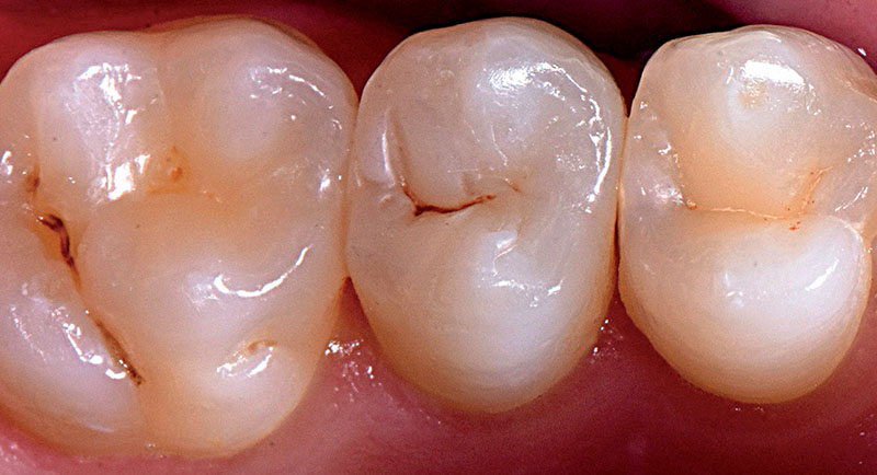 VOCO-composites-fig19