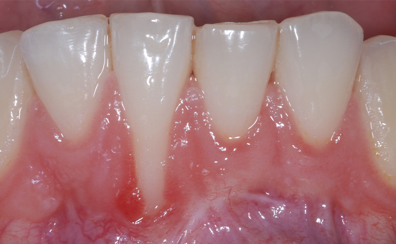 fig-01-recessions-gingivales-semtob
