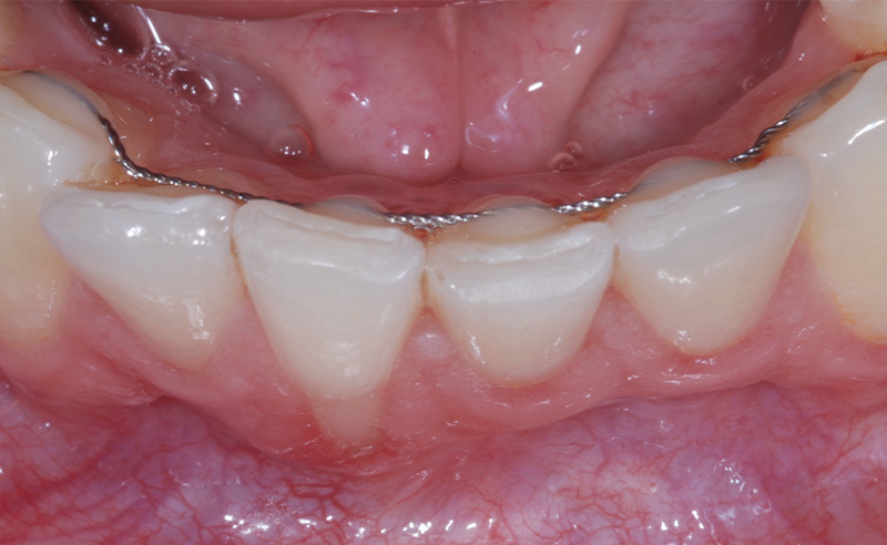 fig-02-recessions-gingivales-semtob