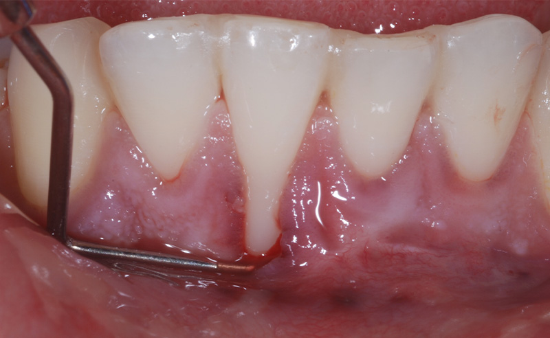 fig-03-recessions-gingivales-semtob