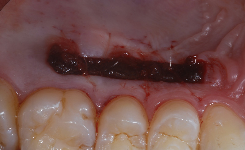 fig-04-recessions-gingivales-semtob