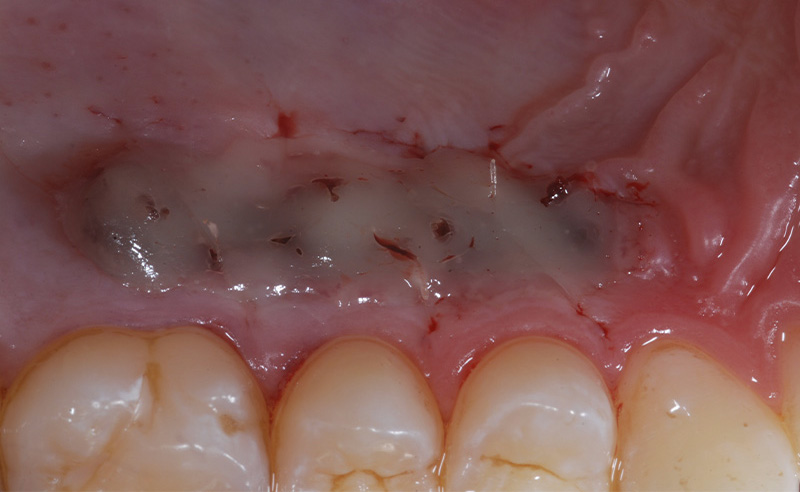 fig-05-recessions-gingivales-semtob