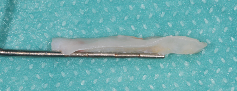 fig-07-recession-gingivale-semtob