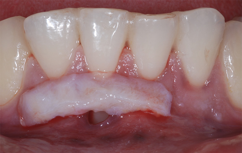fig-08-recession-gingivale-semtob