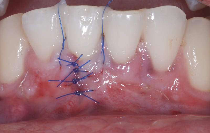 fig-10-recession-gingivale-semtob