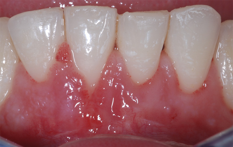 15 jours post-opératoire