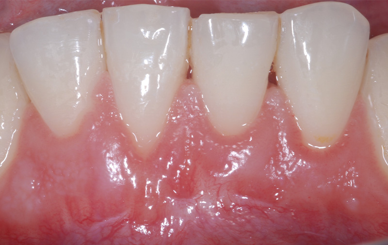 1 mois post-opératoire