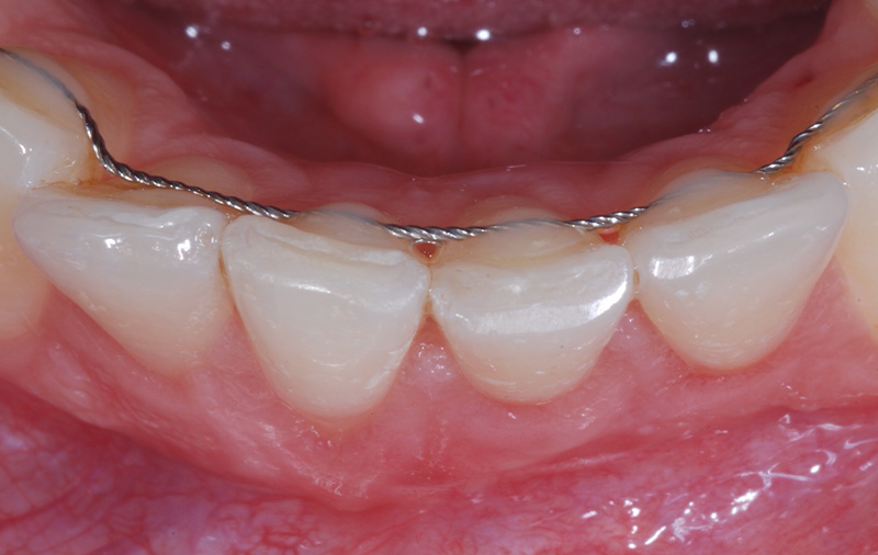 1 mois post-opératoire