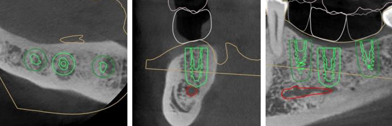 fig-06-amar-chirurgie-guidee