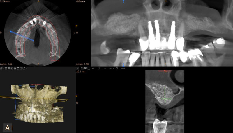 fig-12-amar-chirurgie-guidee