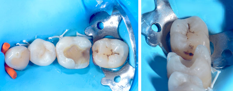 onlay-inlay-protection-dentinaire-comblement-des-contre-dépouilles