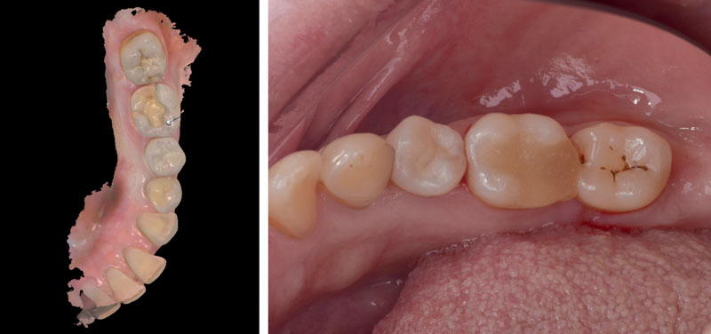 empreinte-optique-sectorielle-temporisation-avec-un-composite-souple-onlay