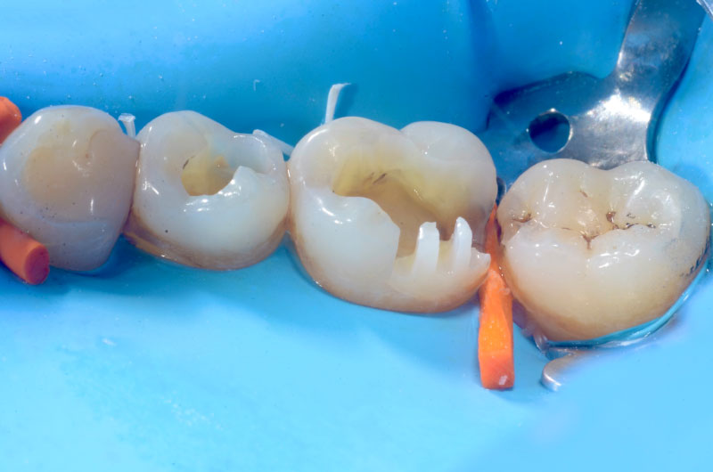 inlay-onlay-rainure-de-profondeur-controlées-à-2-mm-sur-la-cuspide-DL