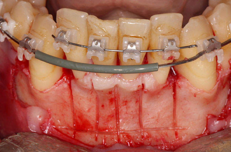 fig03bis-corticotomies