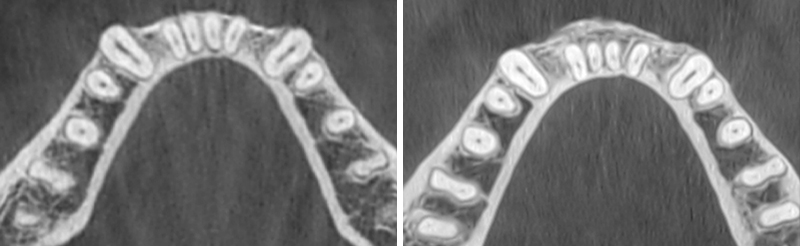 fig10bis-corticotomies