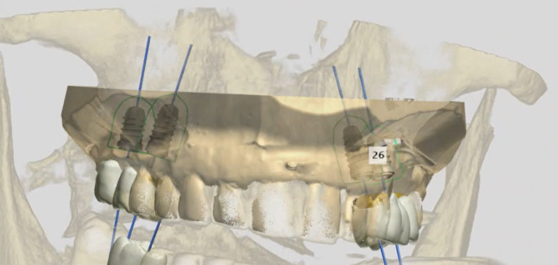 Figure 10 Planification prothétique traitement réhabilitation