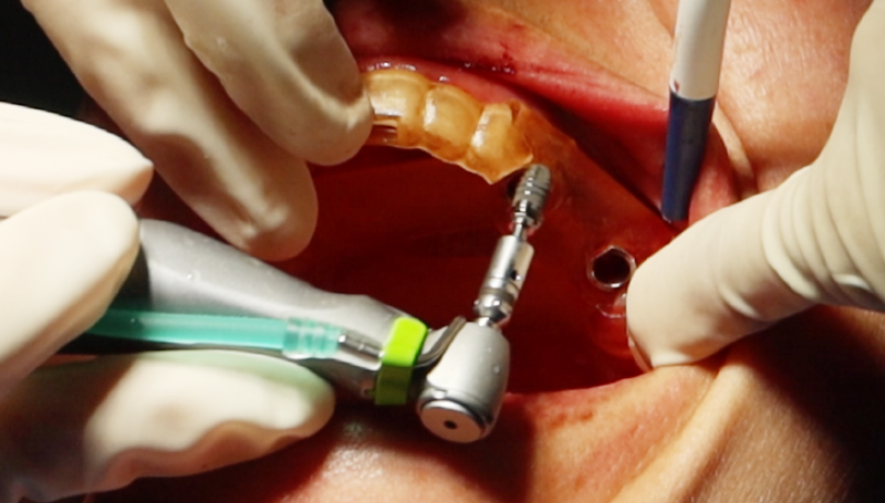 12Figure 12 Traitement pose implantaire guidée