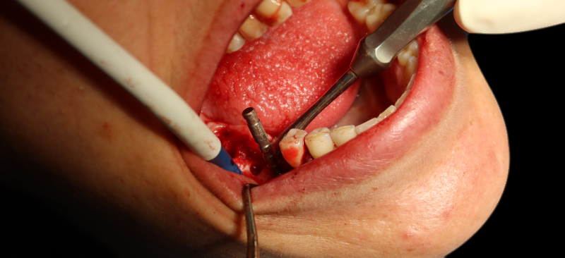 Figure 13 Traitement préparation du lit implantaire à main levée