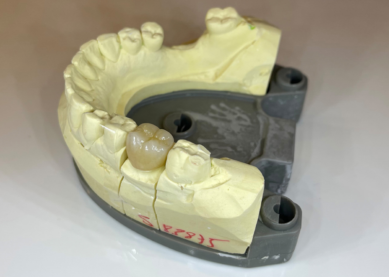 Figure 14 Couronne full Zircone sur 36