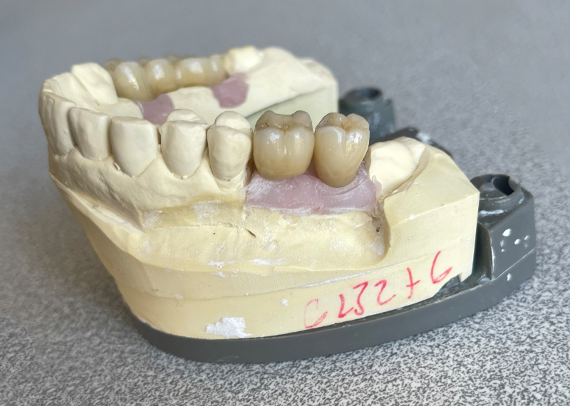 Figure 16 Couronnes implanto-portées et bridge implanto-porté