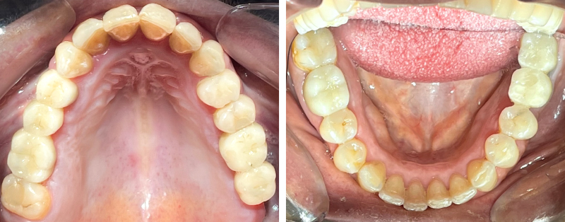 Figure 17 (a) Situation finale traitement