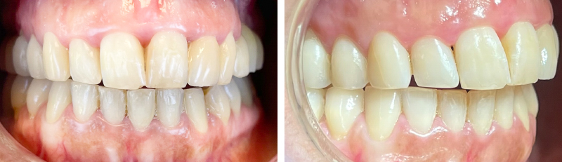 Figure 17 (b) Situation finale traitement