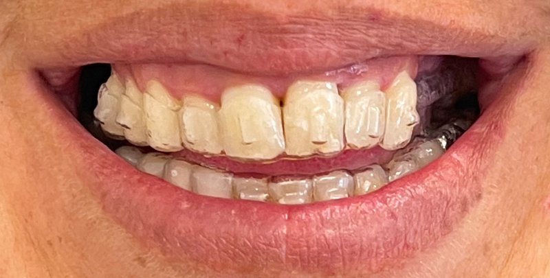 3-2Figure 3 (a) Début du traitement par aligneurs-rehabilitation3-2